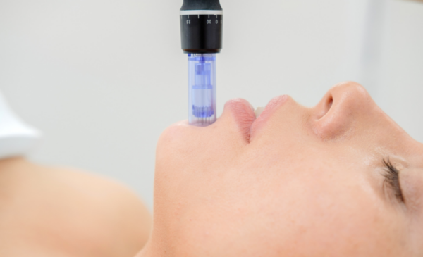 Try a Microneedling in Blouberg for Healthier Skin