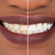 teeth whitening in cape town