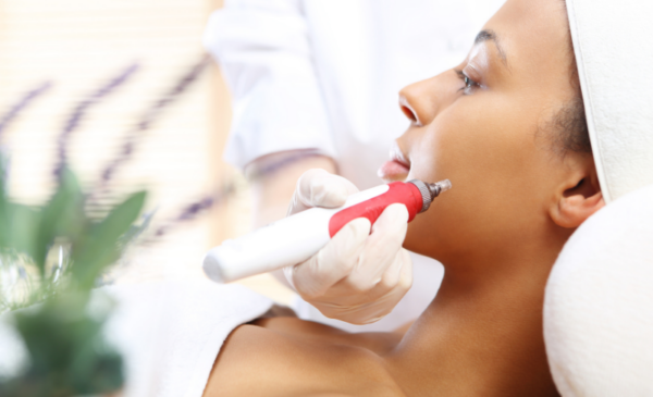 Get beautiful flawless skin with a microneedling session