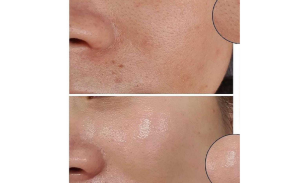 Get flawless skin with a cryofacial - Image 2
