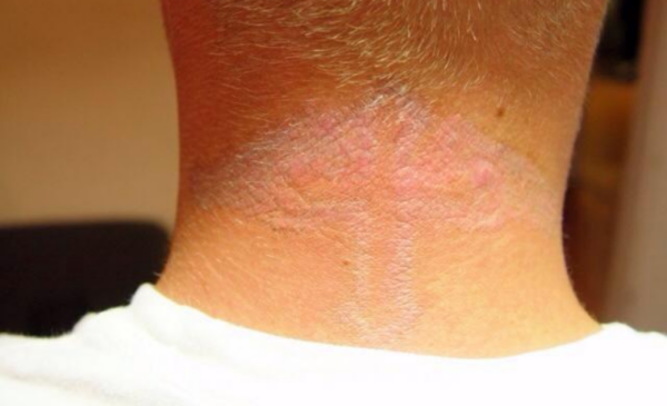 A tattoo removal session - Image 3