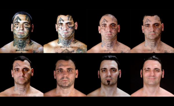 A tattoo removal session - Image 2