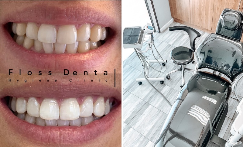 Get this teeth whitening kit for home use - Image 2