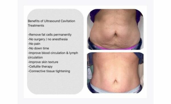 Ultrasonic cavitation: Losing fat without a sweat - Image 2