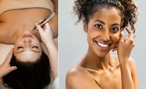 Get regenerated skin with one microneedling session