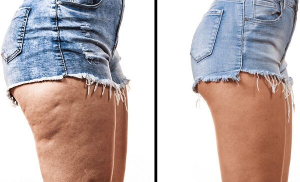 Choose the most suitable slimming package for yourself - Image 2