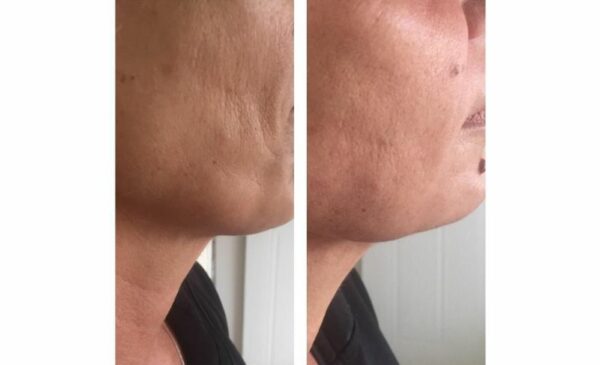 Where to get micro-needling done in Port Elizabeth - Image 2