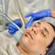 microneedling session Cape Town spa S&S Aesthetics