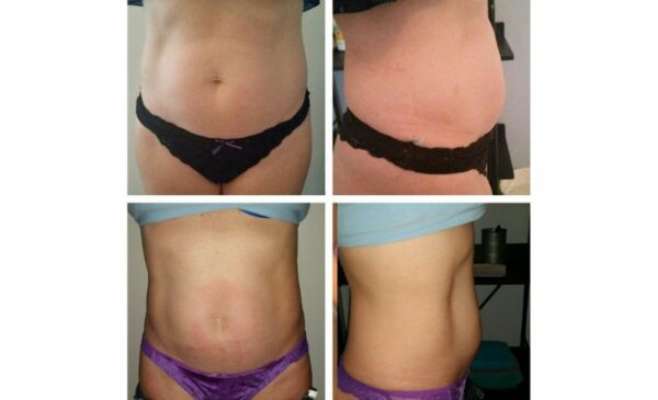 A New You: Painless Slimming Treatments - Image 2