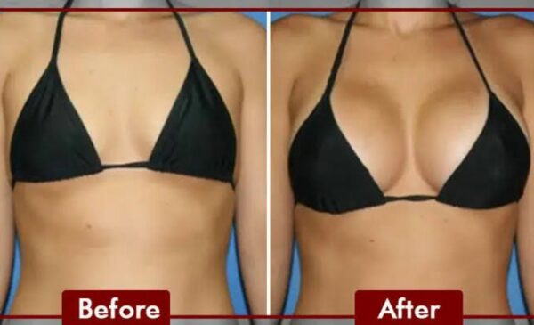 A Breast Lift Treatment or Butt Lift in Bothasig - Image 2
