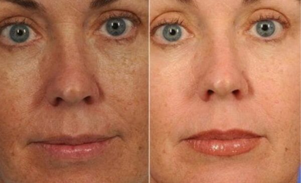 Non-Surgical Botox Treatment in Cape Town - Image 2