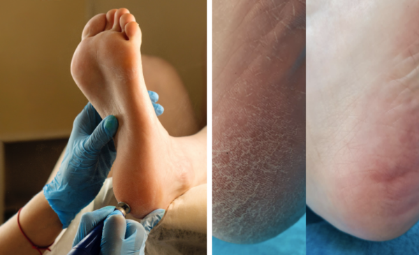 45-min chemical foot peel for 1