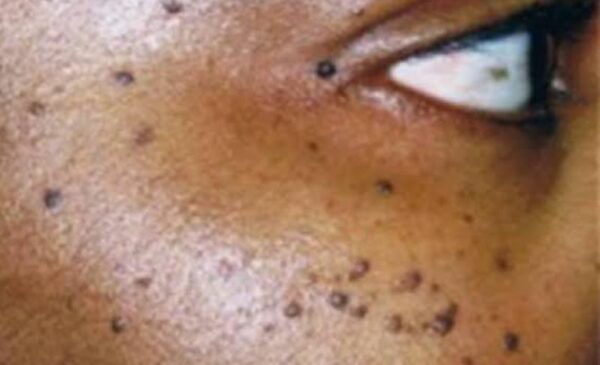 Skin Tag Removal in Blouberg - Image 5