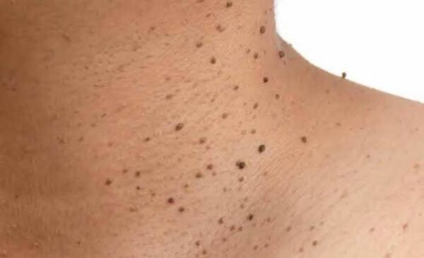 Skin Tag Removal in Blouberg - Image 2