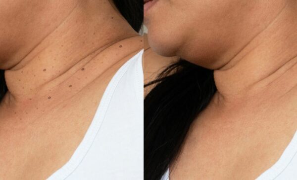 Skin Tag Removal in Blouberg - Image 3
