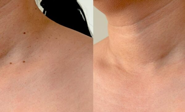 Skin Tag Removal in Blouberg - Image 4