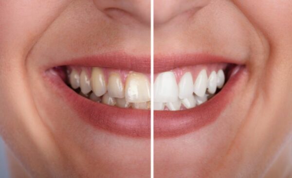A 30-Minute Teeth Whitening Treatment for 1 in Umhlanga