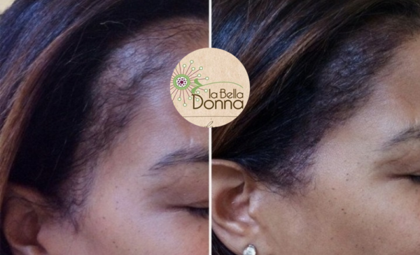 A Confidence-Boosting Scalp Micropigmentation Session