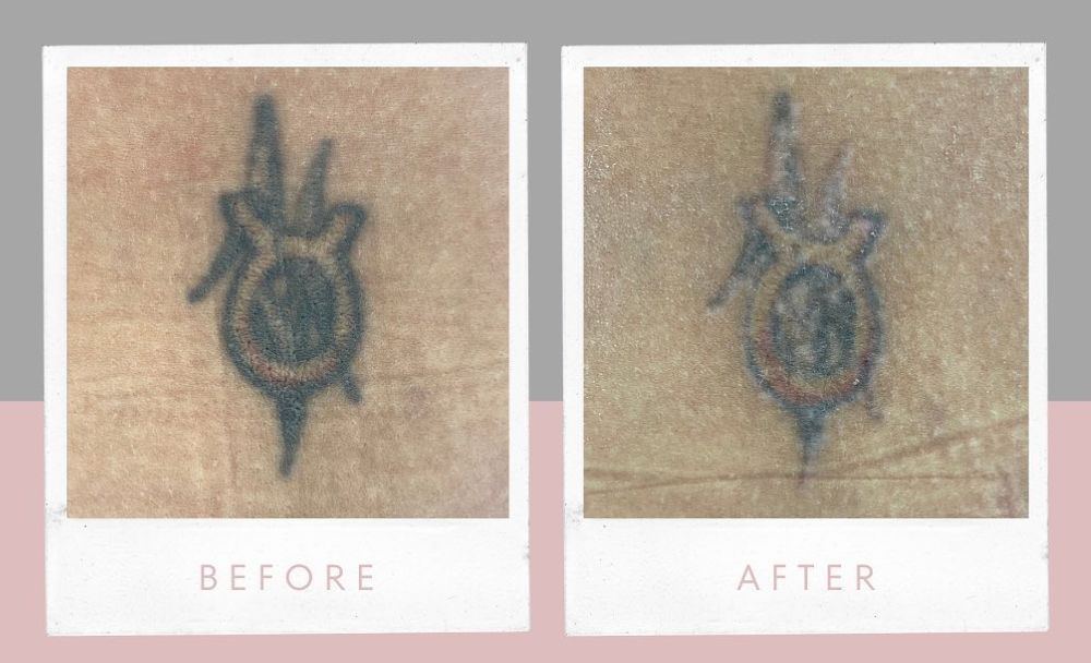 Remove Unwanted Tattoos with Laser Tattoo Removal in Table View