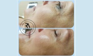 RF Skin Tightening and a Glycolic Peel in Pretoria