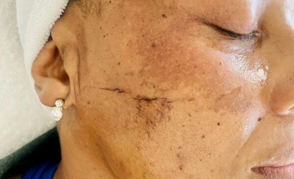 Smooth and Hydrate Your Skin with a Mini-Facial and Dermaplaning in Fourways - Image 3