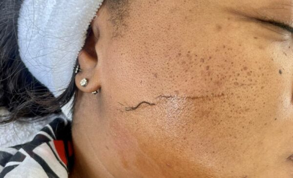 Smooth and Hydrate Your Skin with a Mini-Facial and Dermaplaning in Fourways - Image 4