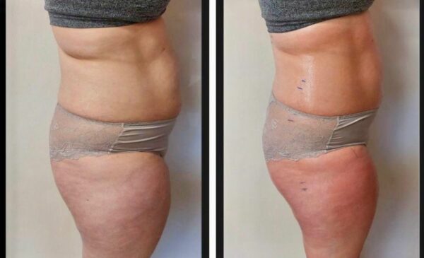 A Flattering Set of Laser Lipo Slimming Sessions In Umhlanga Ridge - Image 2