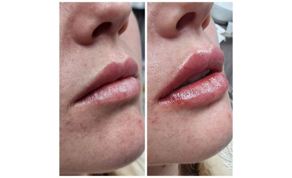 Boost Your Confidence with Lip Filler and a Brightening Peel in Durban North - Image 2