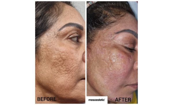 Boost Your Confidence with Lip Filler and a Brightening Peel in Durban North - Image 3