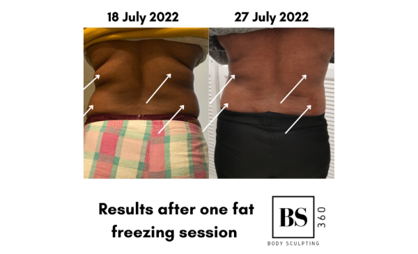 Fat-Freezing and Cavitation in Oakdale