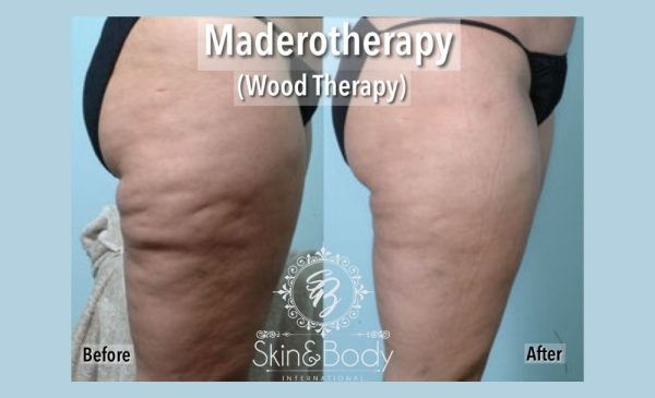 Wood Therapy Sessions in Lenasia