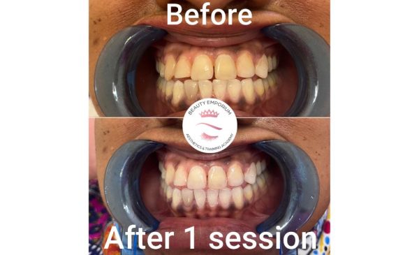 Get a Brighter, Whiter Smile with a 30-Minute Teeth Whitening Treatment in Wonderboom - Image 2