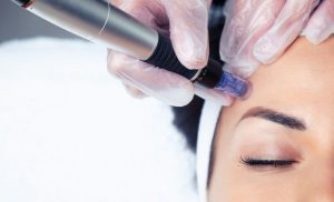 Microneedling in Milnerton