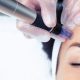 Microneedling in Milnerton