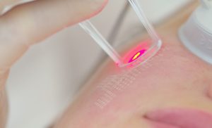 Laser Skin Rejuvenation Sessions at Oriental City Shopping Centre