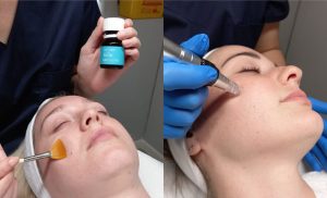 A Lamelle Chemical Peel With Microneedling in Claremont