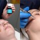 A Lamelle Chemical Peel With Microneedling in Claremont