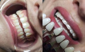 A before and after photo of a woman having a dental-grade teeth-whitening session at Bella Donna Beauty & Aesthetics Studio in Edenvale,