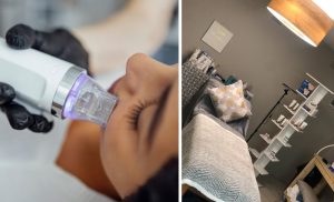 Microneedling and a Chemical Peel in Langebaan