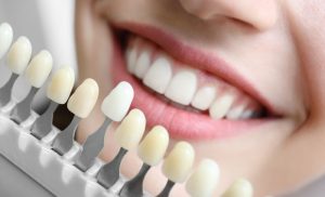 Professional Laser Teeth Whitening in Langebaan