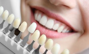 A stock photo of a woman after a professional teeth whitening session