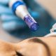 A Microneedling Combo in Durbanville