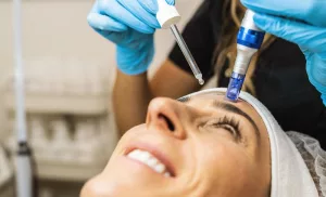 Microneedling session