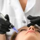 microneedling