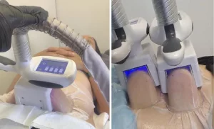 Fat Freezing