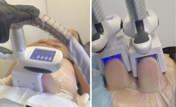 Fat Freezing