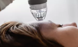 Microneedling in Bryanston