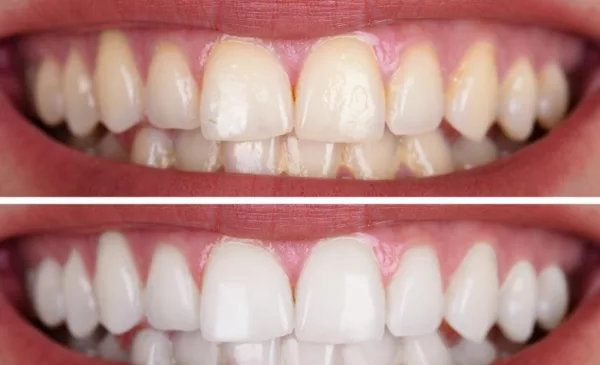 Zoom Teeth Whitening for a Radiant, Confident Smile - Image 2