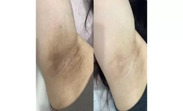 Reduce dark spots caused by hyperpigmentation with IPL Laser - Image 4