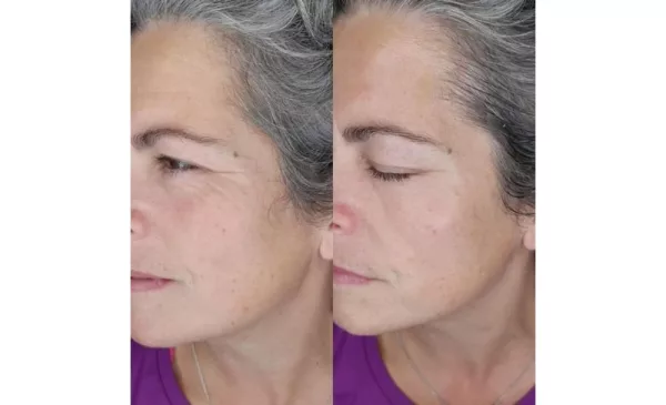 Reduce Signs of Aging with a Galvanic Face Lift - Image 4